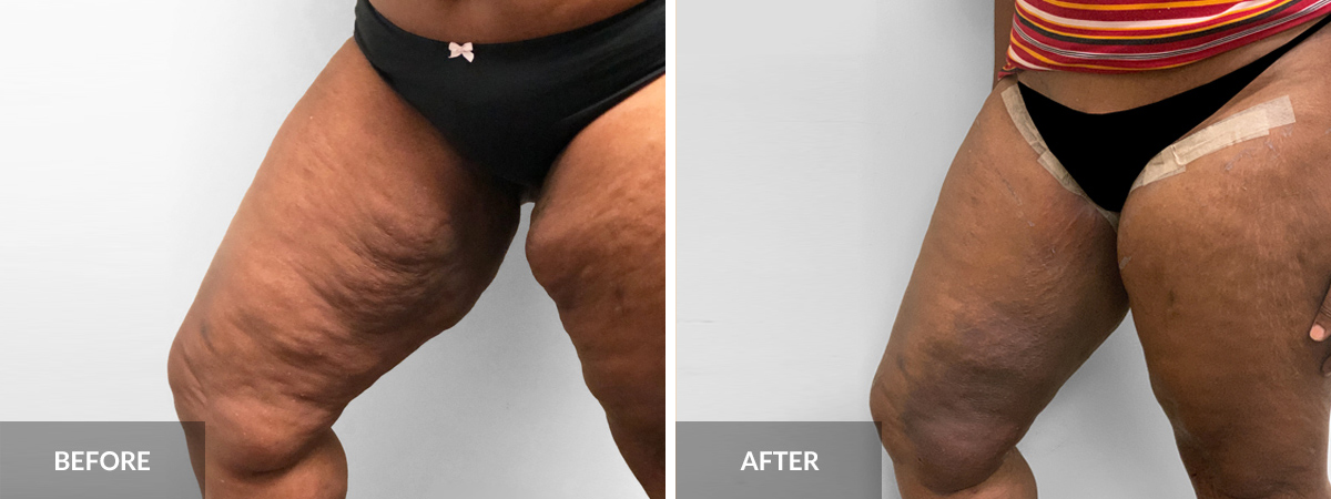 Complication Rates of Inner Thigh Lifts - Explore Plastic Surgery