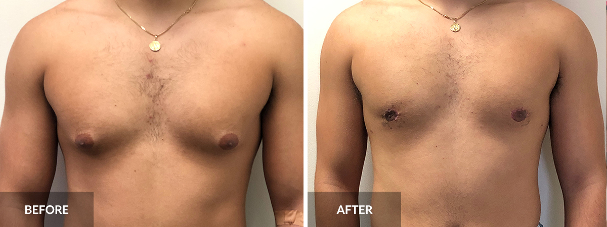 What is the difference between the grades of gynecomastia surgery?