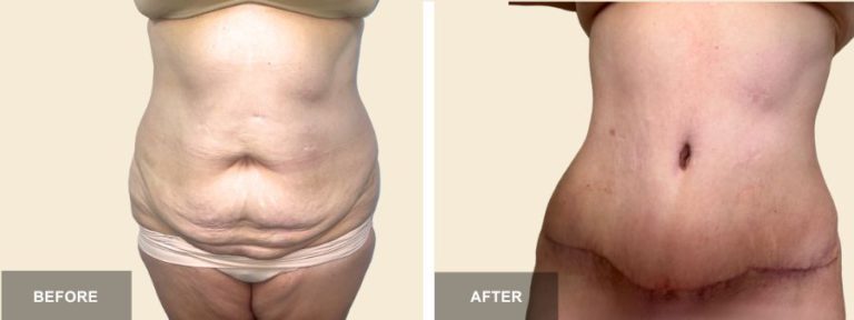 KE DRE Tummy Tuck x