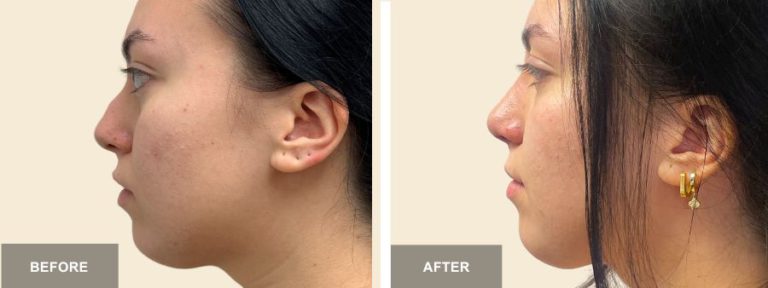 LV DRC Rhinoplasty  x