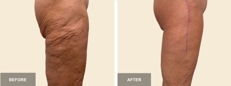 SC DRE side thigh lift  x