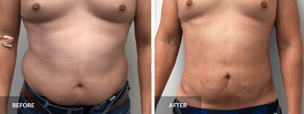 Abdominal Liposuction - KleinLipo - Liposuction Surgery of Orange