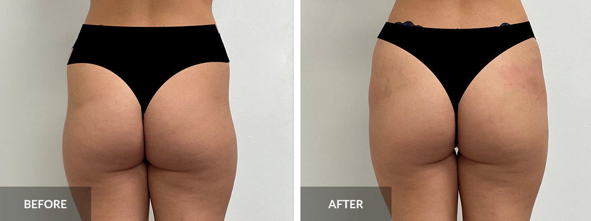 BBL Brazilian Butt Lift cosmetic surgery - orlando FL best surgeon
