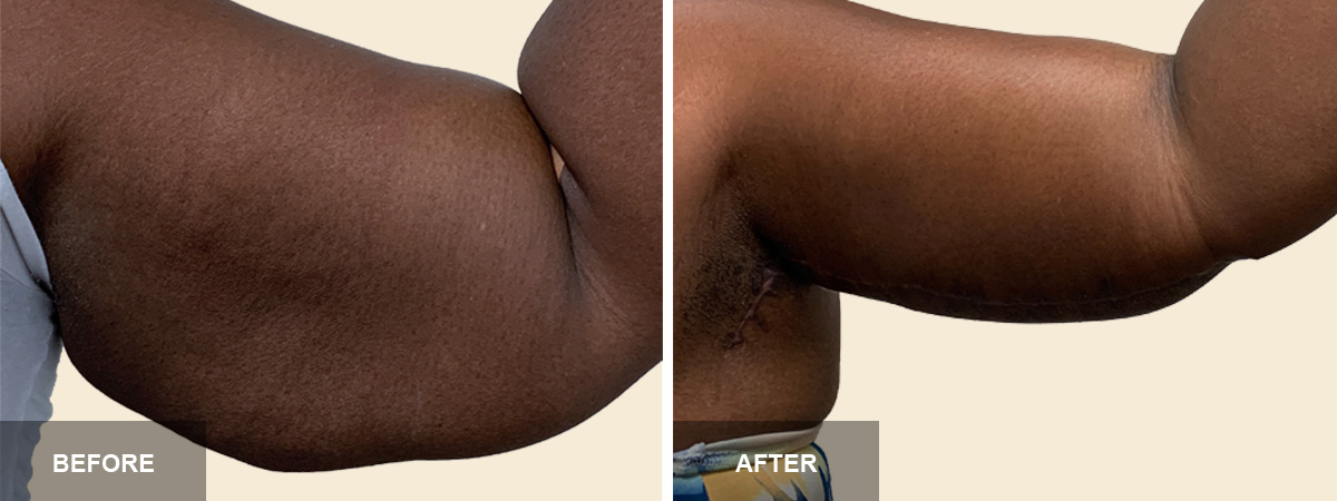 Liposuction Before and After  South Florida Center for Cosmetic