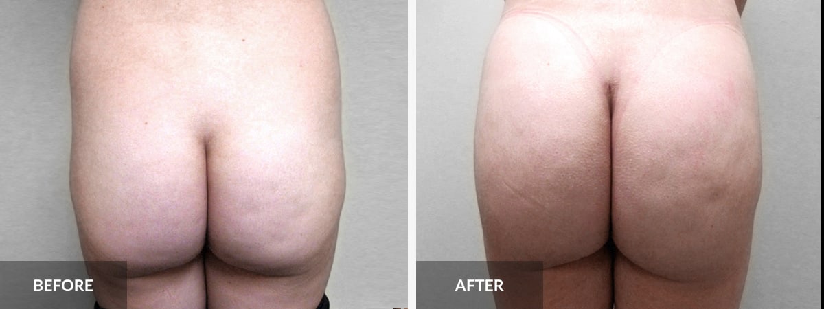 Patient 65642128  Booty-Ful Butt Lift® Before & After Photos