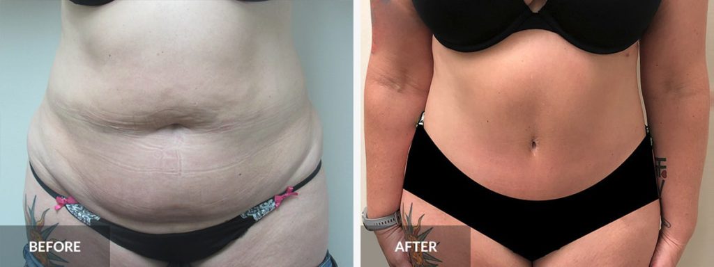  Tummy Tuck Dr. Pinnella x