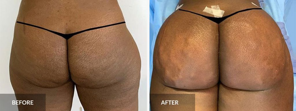How to Speed Up Your Brazilian Butt Lift Recovery: Expert Tips and Tricks -  Miami Center For Plastic Surgery