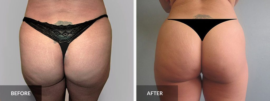 What is a BBL (Brazilian Butt Lift)? Benefits, Costs, & More
