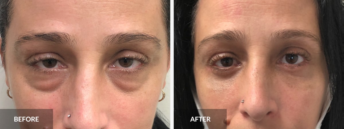 10 Best Clinics for Eye Bag Removal in India 2023 Prices