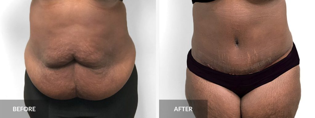  Tummy Tuck Dr. Alexander x