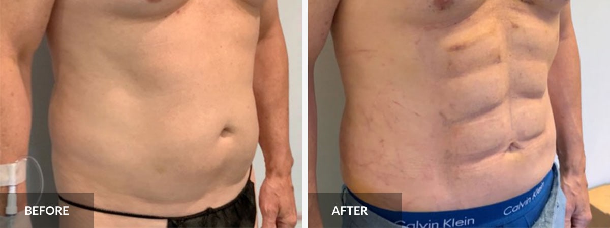 Abdominal Etching  South Florida Center for Cosmetic Surgery