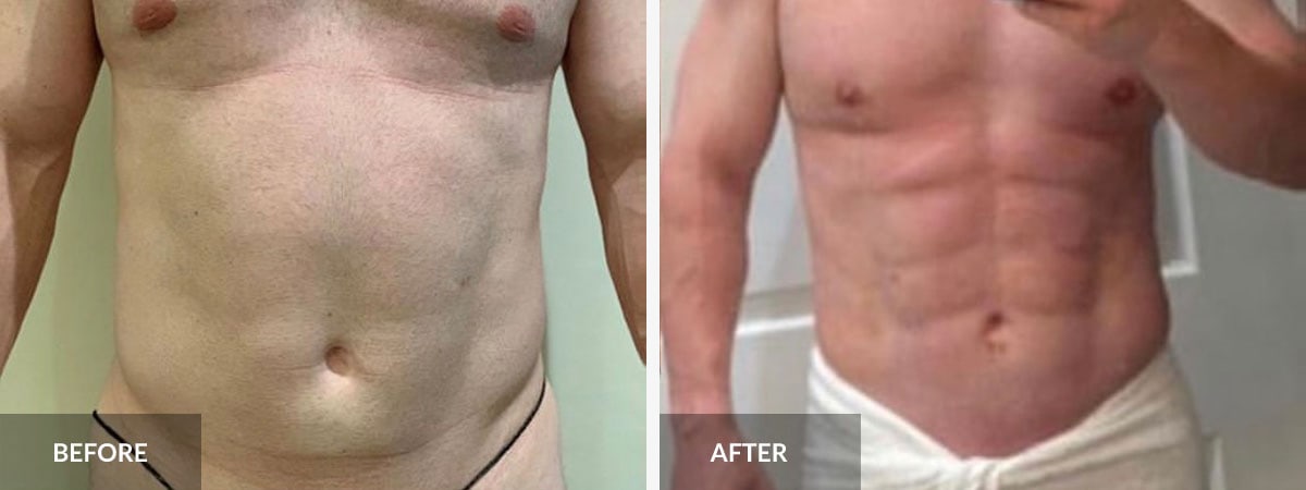 Abdominal Etching  South Florida Center for Cosmetic Surgery