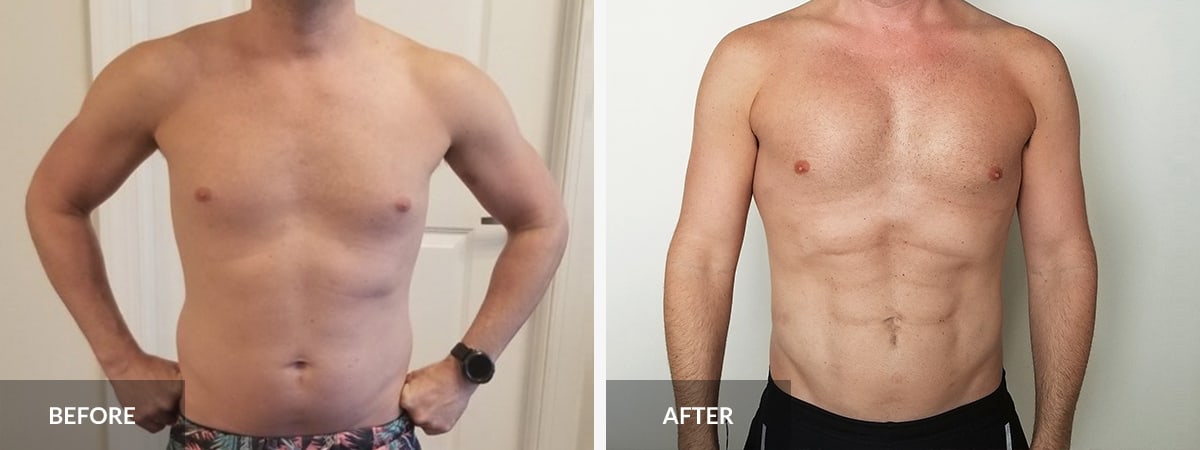 Ab Etching for Men San Jose, Abdominal Liposuction Palo Alto, Body