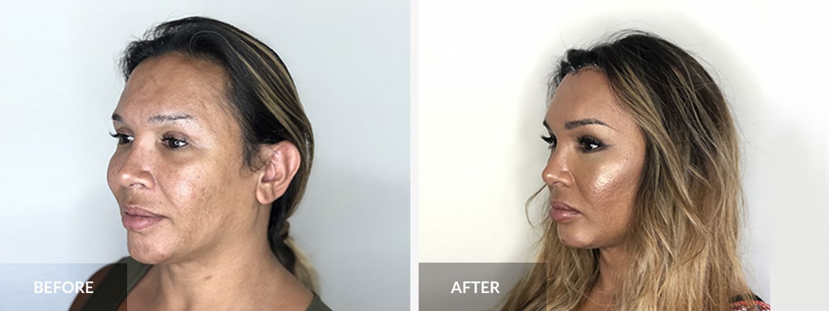 Facial Feminization Surgery Before And After South Florida Center For