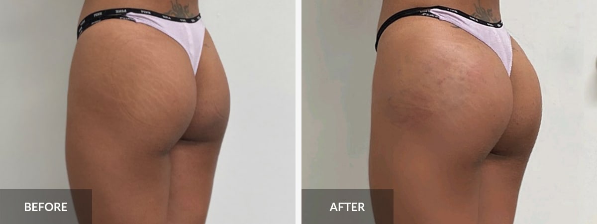 Non-Invasive Brazilian Butt Lift: The BBL Look Sans Surgery — FACE
