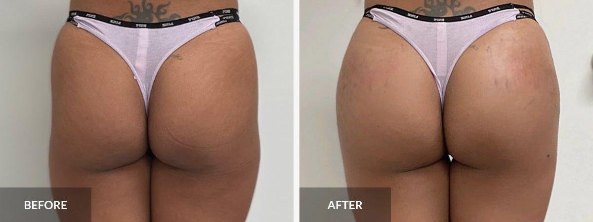 BBL [Before & After] - Body Sculpting with Orthosculpt