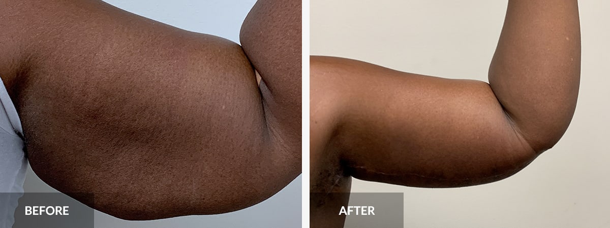 Brachioplasty: Cost, Recovery, Before and Afters of Arm Lift
