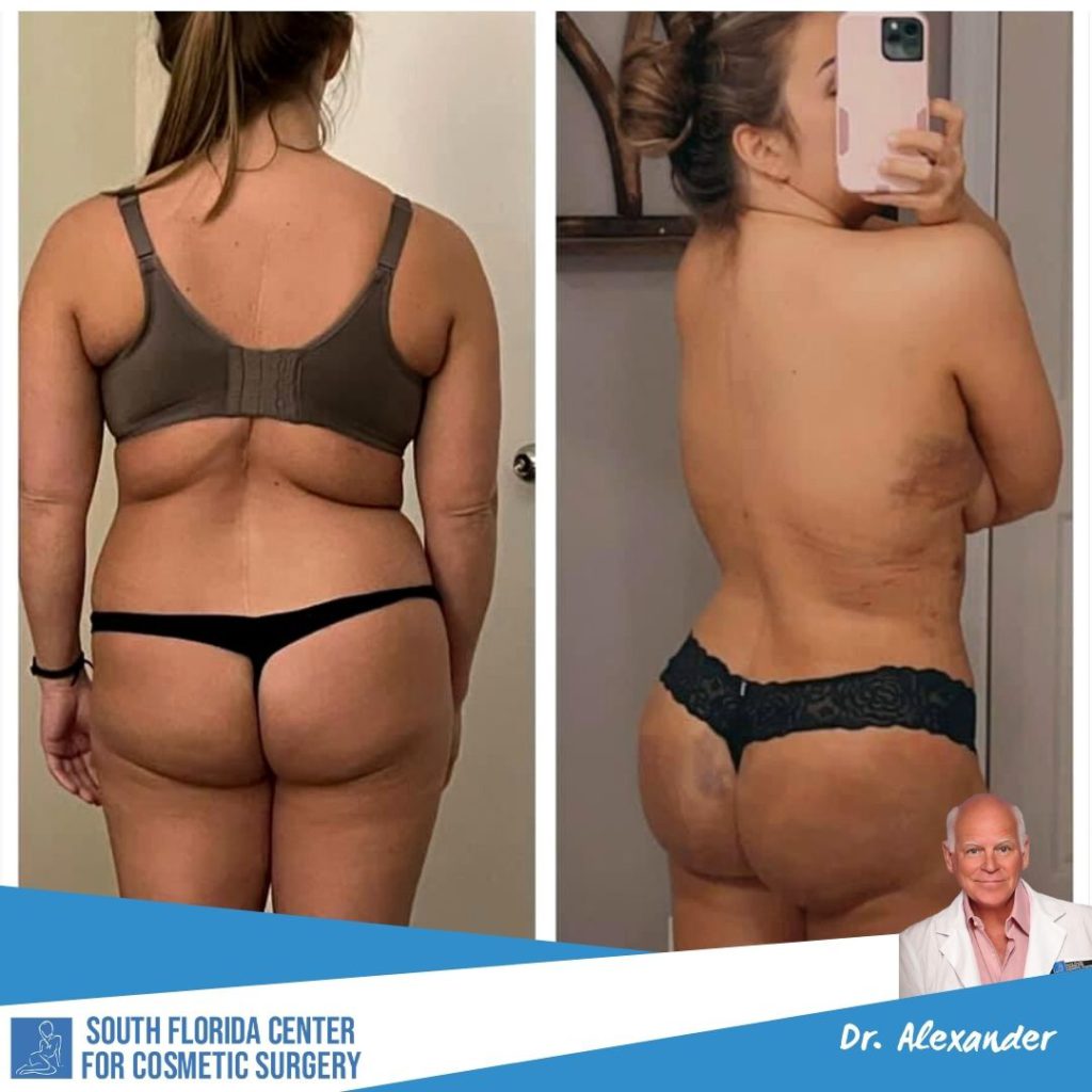 How Much Bigger Can the Bum Get with Brazilian Butt Lift Surgery?