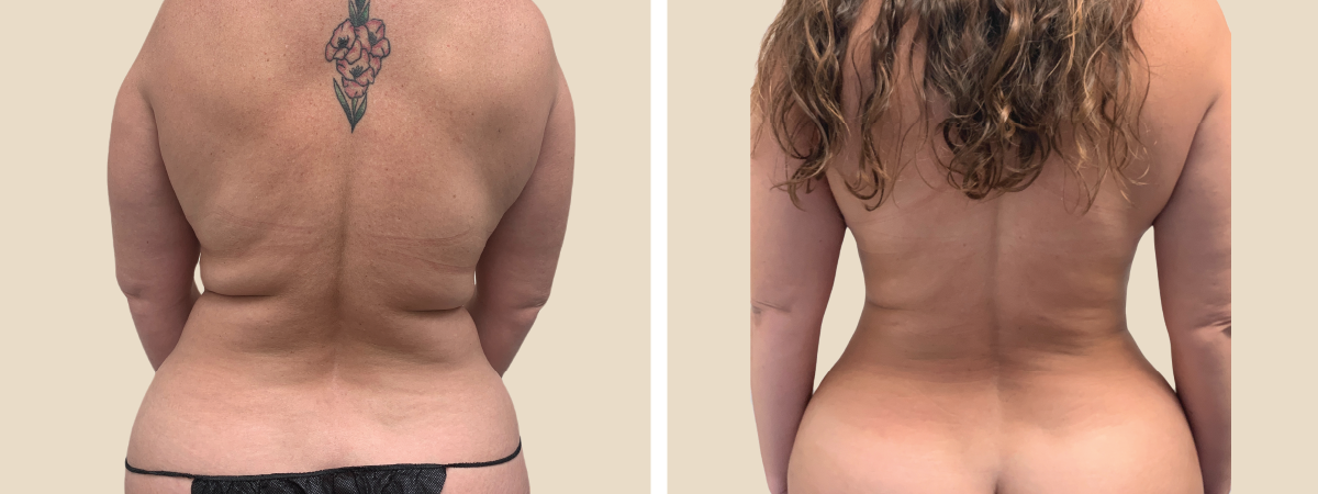 Sculptra BBL Before and After  South Florida Center for Cosmetic Surgery
