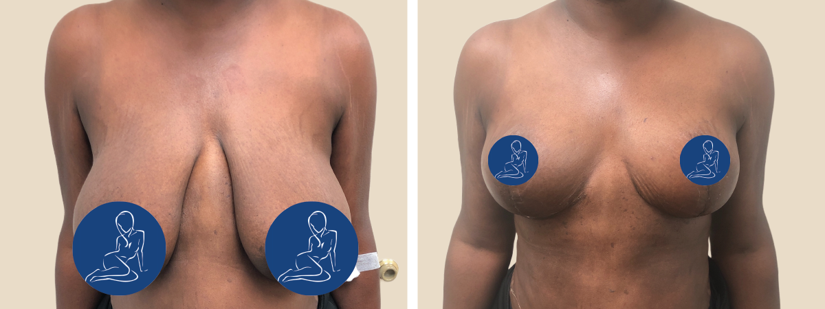 Breast Reduction in Miami 33131